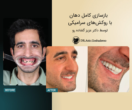 بازسازی کامل فک با ایمپلنت All-on-X توسط دکتر عزیز گشاده&zwnj;رو